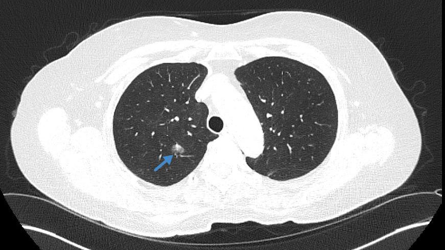 Beste Chancen dank früher Diagnose: CT-Aufnahme der Lunge einer älteren Patientin und ehemaligen Raucherin mit auffälligem Herd (siehe blauer Pfeil). Die weitere Abklärung ergab, dass es sich dabei um einen bösartigen Tumor handelt. Die Patientin konnte erfolgreich operiert werden und hat daher beste Aussichten dauerhaft geheilt zu sein. © TUM Klinikum